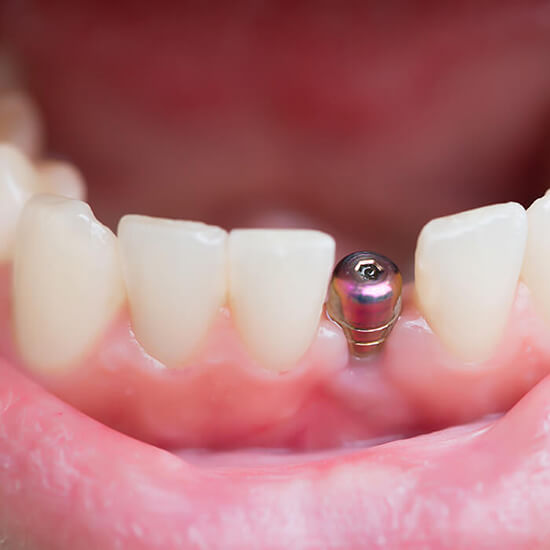  A mouth with a dental implant showing